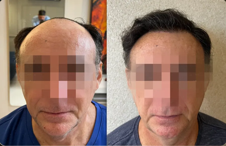Antes e depois de transplante capilar FUE, paciente 1