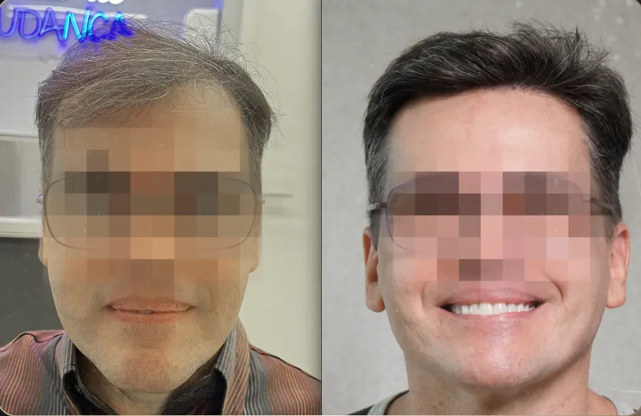 Antes e depois de transplante capilar FUE, paciente 2