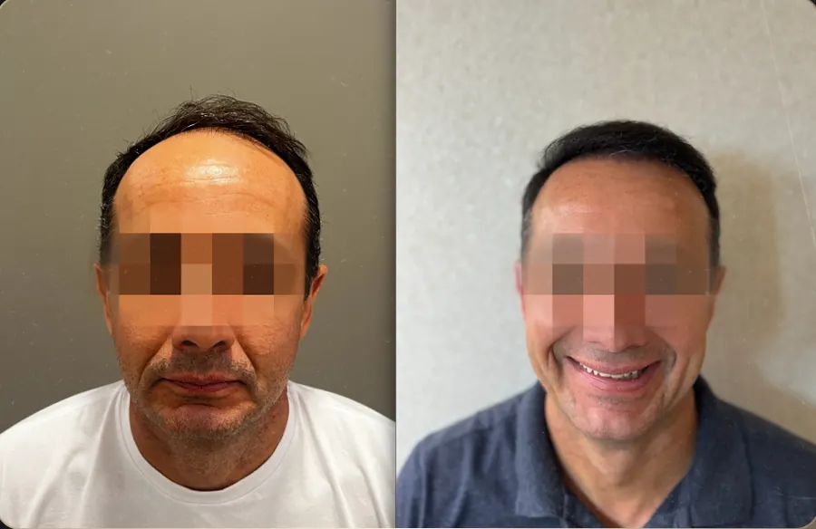 Antes e depois de transplante capilar FUE, paciente 3