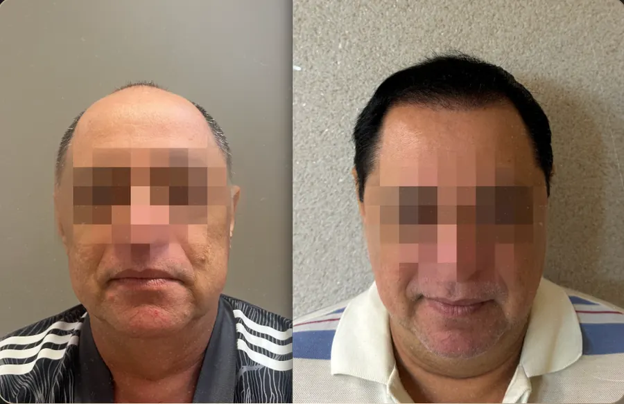 Antes e depois de transplante capilar FUE, paciente 4