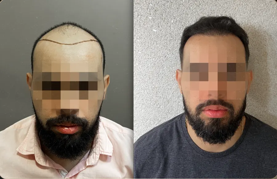 Antes e depois de transplante capilar FUE, paciente 5