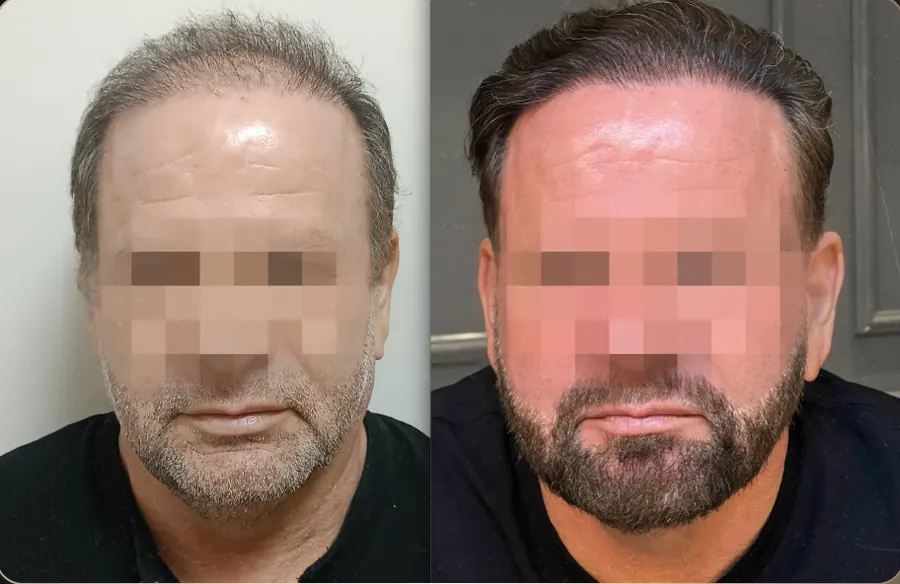 Antes e depois de transplante capilar FUE, paciente 6