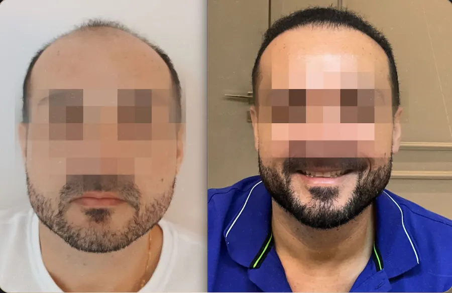 Antes e depois de transplante capilar FUE, paciente 7