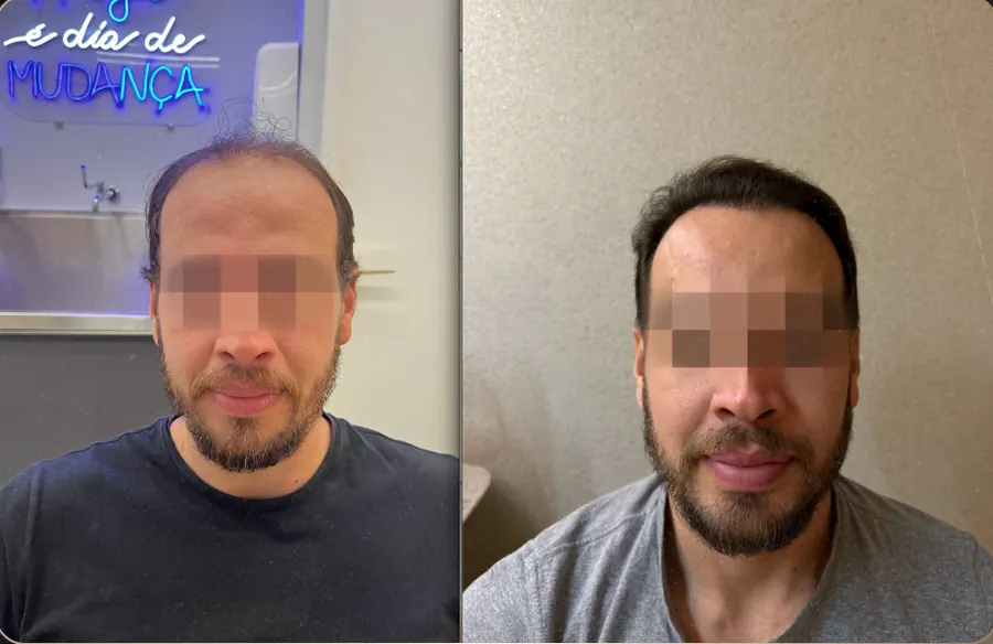Antes e depois de transplante capilar FUE, paciente 8