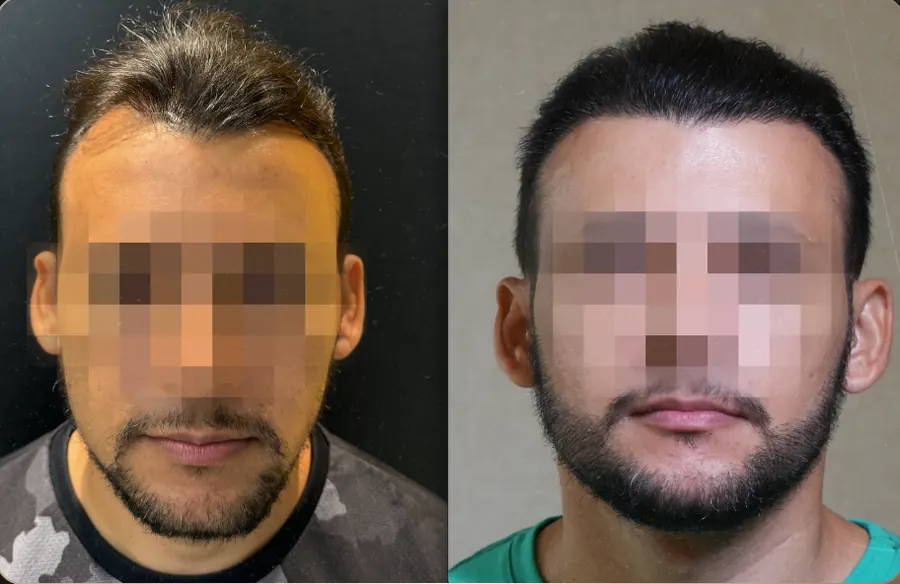 Antes e depois de transplante capilar FUE, paciente 9