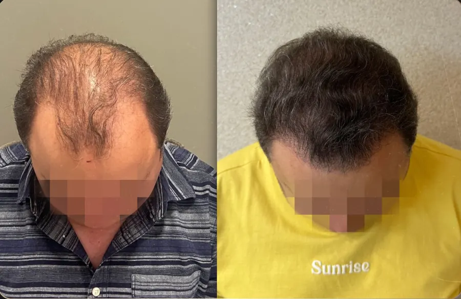 Antes e depois de transplante capilar FUE, paciente 10