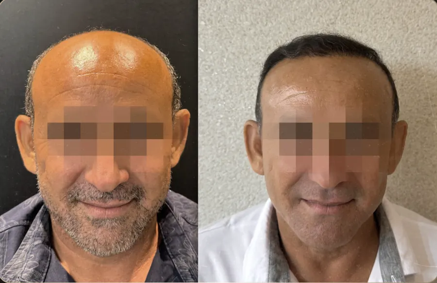 Antes e depois de transplante capilar FUE, paciente 11