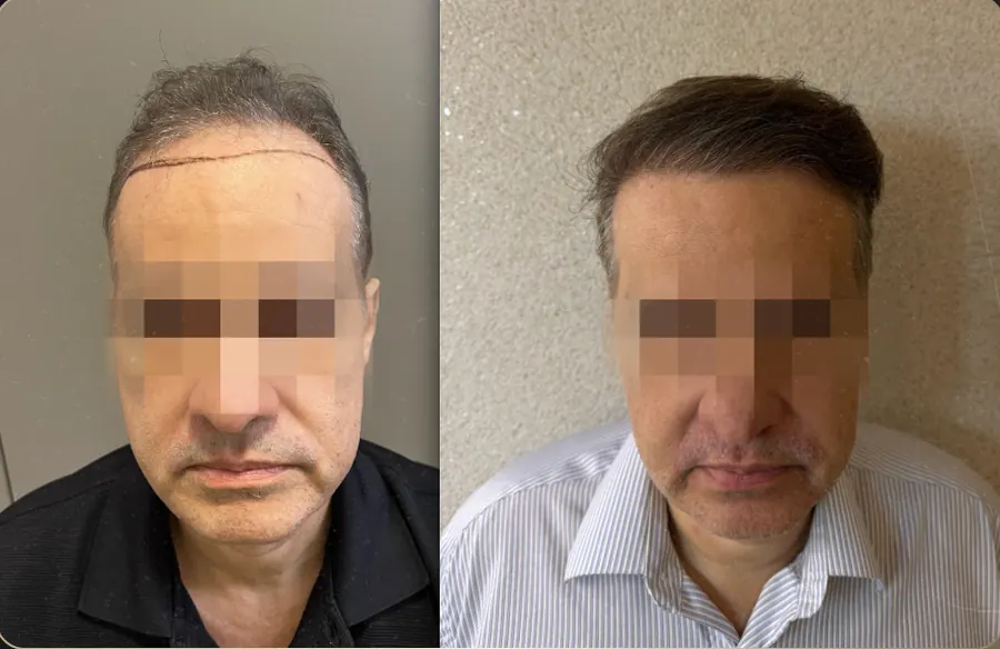 Antes e depois de transplante capilar FUE, paciente 12