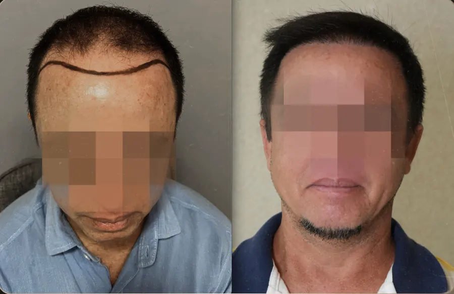 Antes e depois de transplante capilar FUE, paciente 13