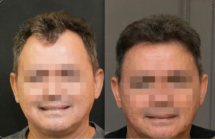 Antes e depois de transplante capilar FUE, paciente 14