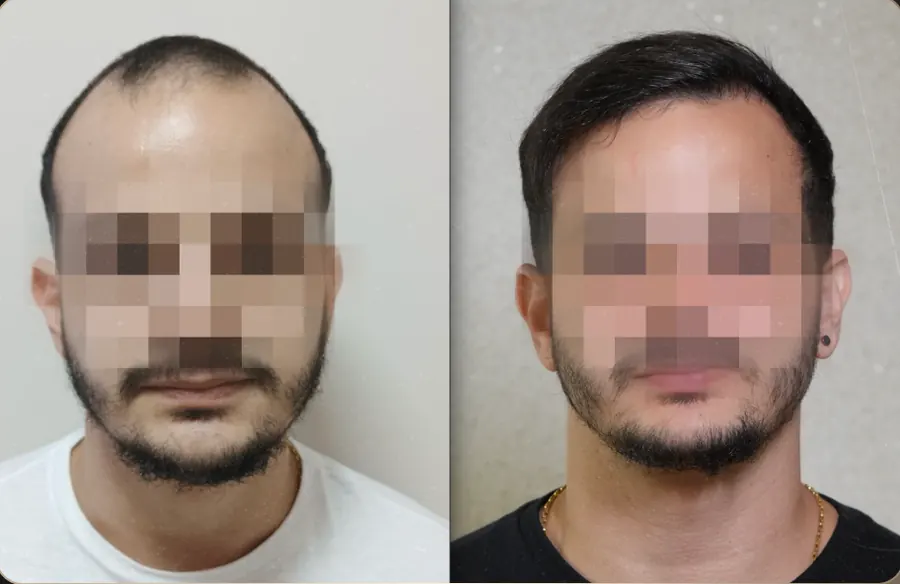 Antes e depois de transplante capilar FUE, paciente 15