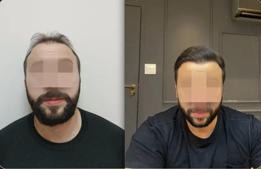 Antes e depois de transplante capilar FUE, paciente 16