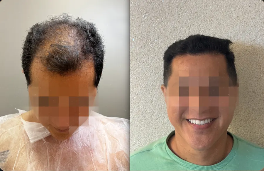 Antes e depois de transplante capilar FUE, paciente 17