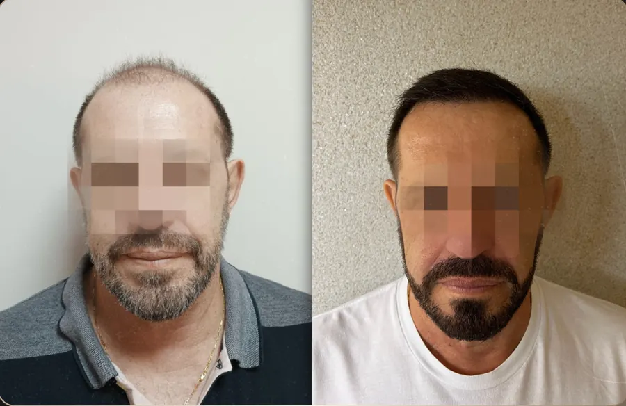 Antes e depois de transplante capilar FUE, paciente 18