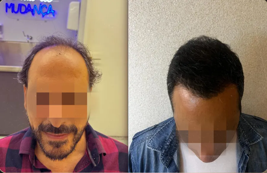 Antes e depois de transplante capilar FUE, paciente 19