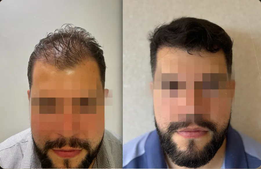Antes e depois de transplante capilar FUE, paciente 20