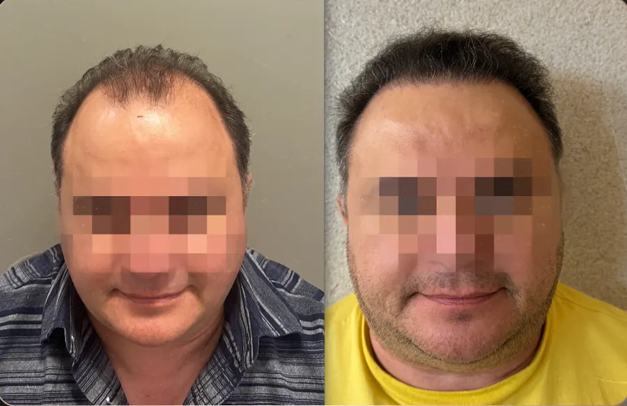 Antes e depois de transplante capilar FUE, paciente 21