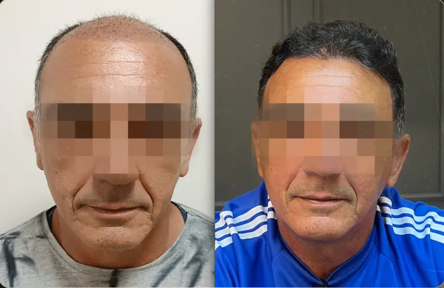 Antes e depois de transplante capilar FUE, paciente 22