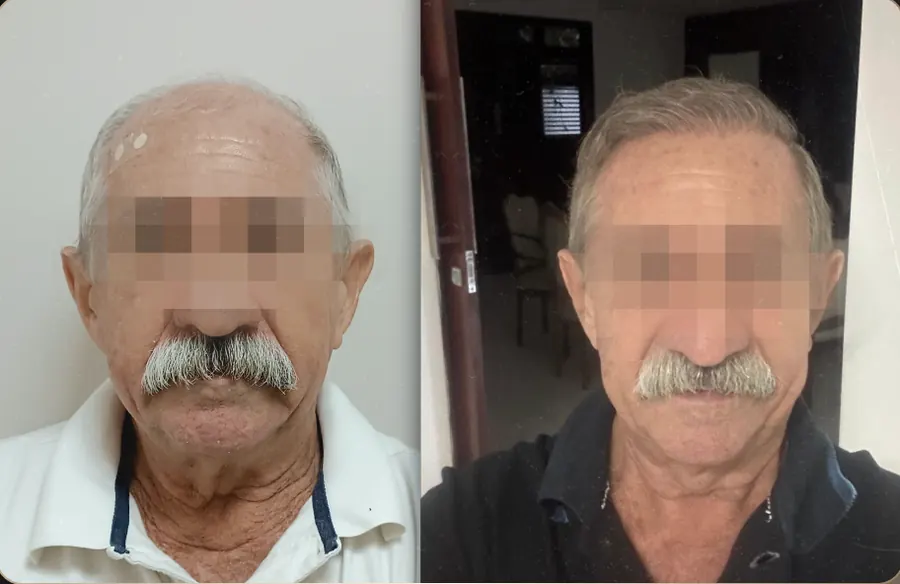 Antes e depois de transplante capilar FUE, paciente 23